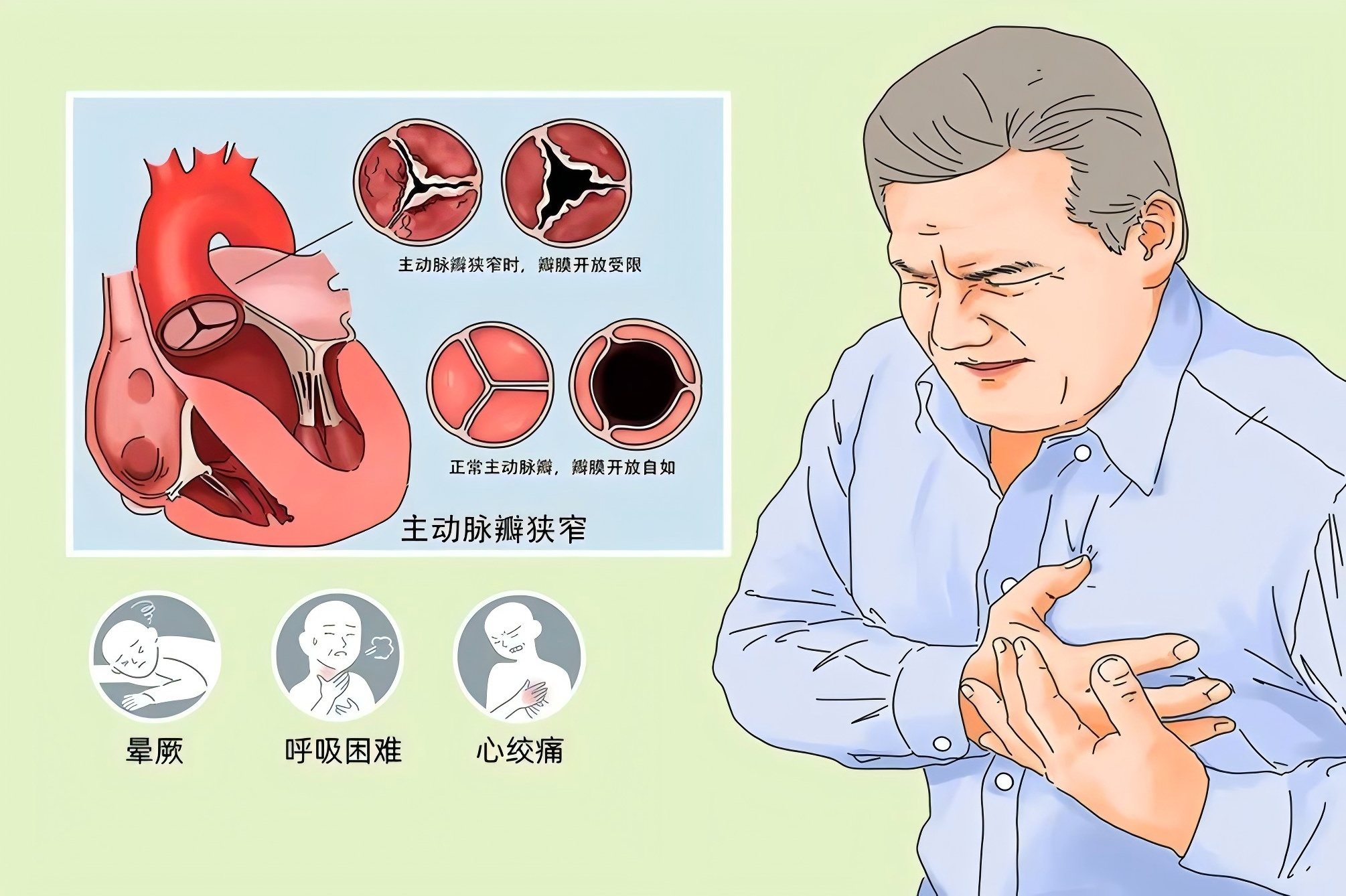 受伤了的“心门”——心脏瓣膜病 - 攀枝花市中心医院