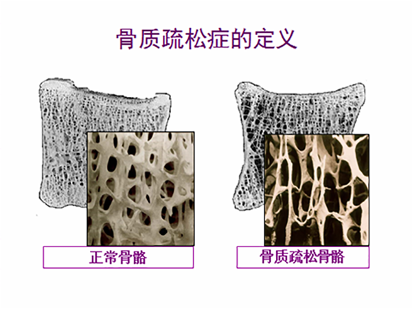 关注骨骼健康，为健康加“骨”劲 - 攀枝花市中心医院